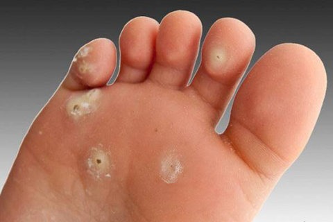 کفش نامناسب و بیماریهای عفونی