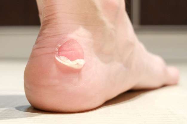 جلوگیری از تاول زدن پا - کفش شهپر